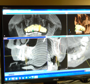 Dental X-ray Exam at Eastmont Family Dental in Wenatchee, WA.